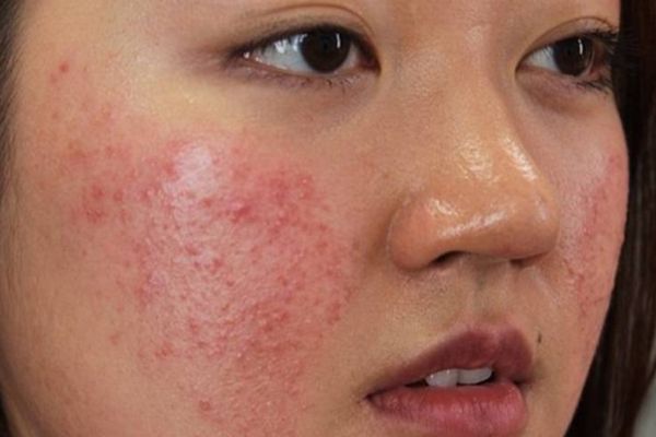 Da mặt bị ngứa: Nguyên nhân, biểu hiện và cách khắc phục hiệu quả