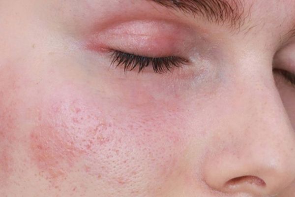 Da mặt bị ngứa: Nguyên nhân, biểu hiện và cách khắc phục hiệu quả