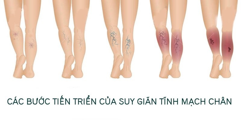 Phù chân: Tại sao ông bà ta lại khuyên ngâm nước muối?